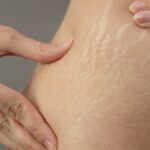 What Are The Types Of Stretch Marks And How To Get Rid Of Them?