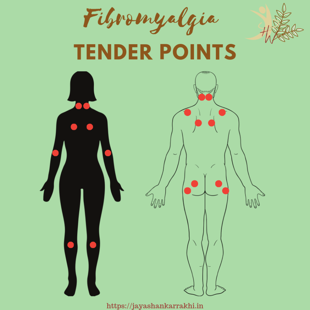Fibromyalgia tender points